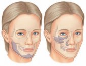 Лицевые имплантаты — в подбородок, скулы