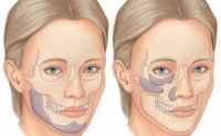 Лицевые имплантаты — в подбородок, скулы